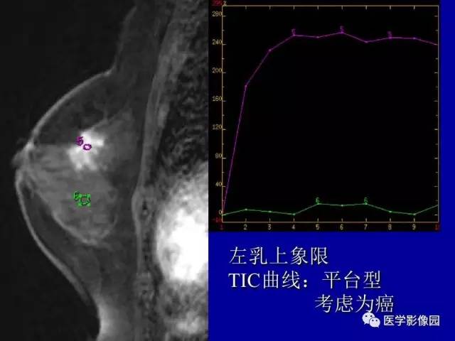 【PPT】乳腺肿瘤影像检查方法与诊断思路