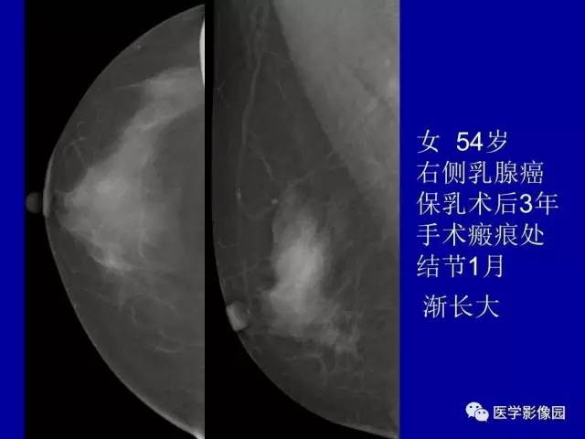 【PPT】乳腺肿瘤影像检查方法与诊断思路