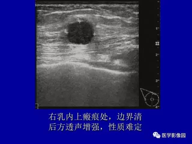 【PPT】乳腺肿瘤影像检查方法与诊断思路