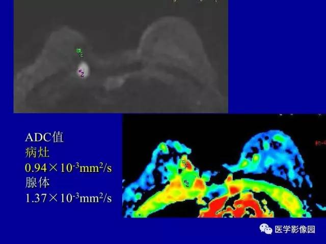 【PPT】乳腺肿瘤影像检查方法与诊断思路