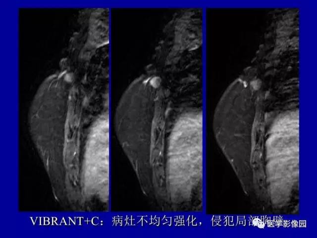 【PPT】乳腺肿瘤影像检查方法与诊断思路