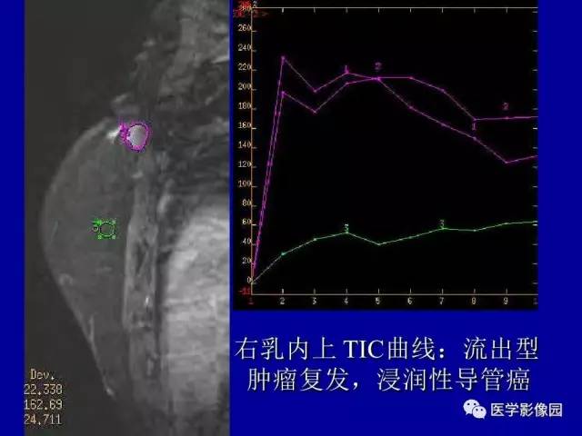【PPT】乳腺肿瘤影像检查方法与诊断思路