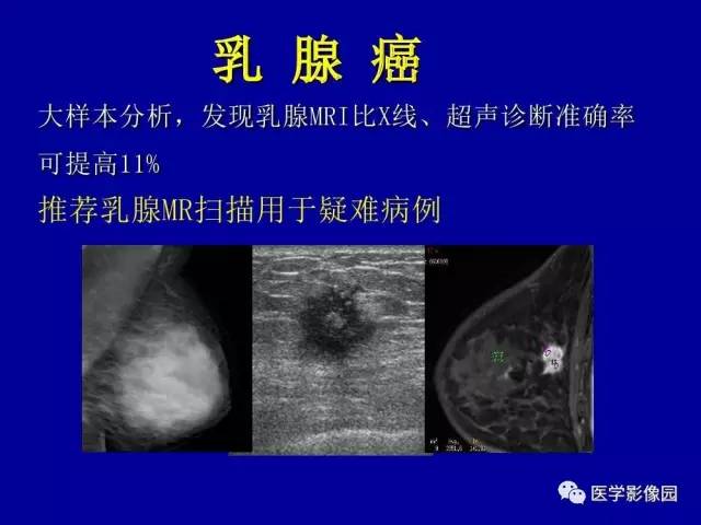 【PPT】乳腺肿瘤影像检查方法与诊断思路