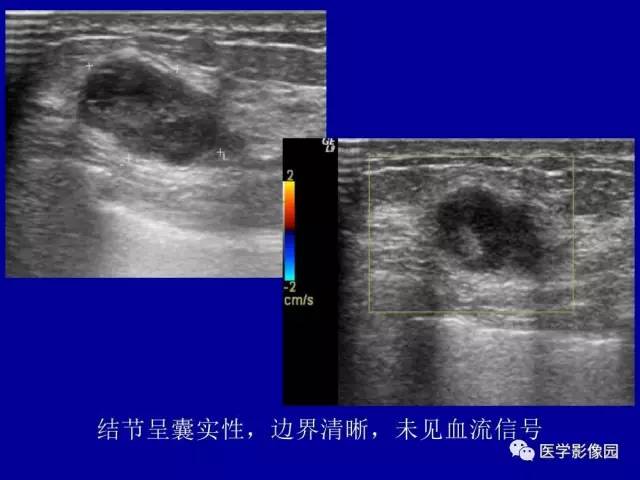 【PPT】乳腺肿瘤影像检查方法与诊断思路