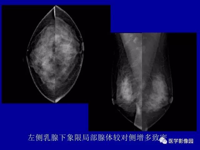 【PPT】乳腺肿瘤影像检查方法与诊断思路