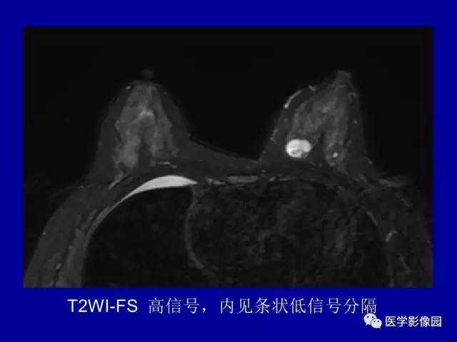【PPT】乳腺肿瘤影像检查方法与诊断思路