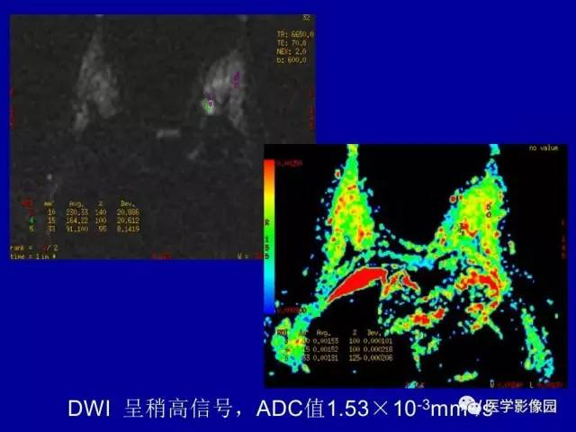 【PPT】乳腺肿瘤影像检查方法与诊断思路