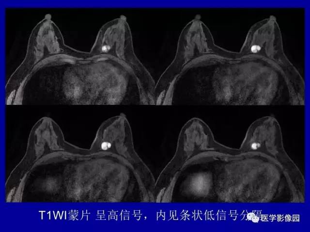 【PPT】乳腺肿瘤影像检查方法与诊断思路