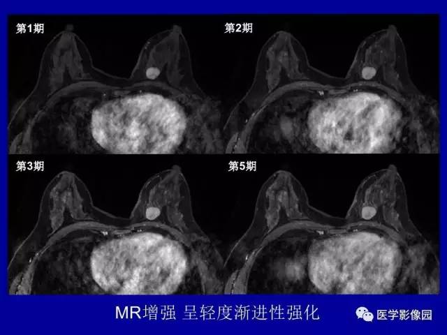 【PPT】乳腺肿瘤影像检查方法与诊断思路