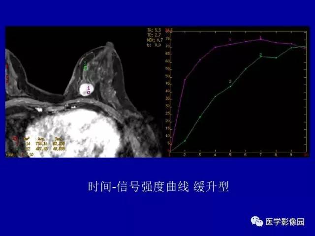 【PPT】乳腺肿瘤影像检查方法与诊断思路