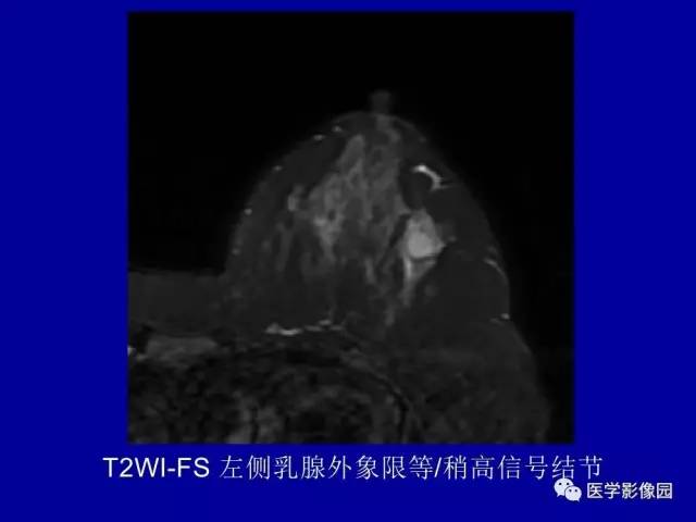 【PPT】乳腺肿瘤影像检查方法与诊断思路