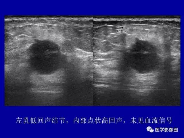 【PPT】乳腺肿瘤影像检查方法与诊断思路