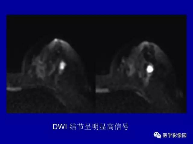 【PPT】乳腺肿瘤影像检查方法与诊断思路