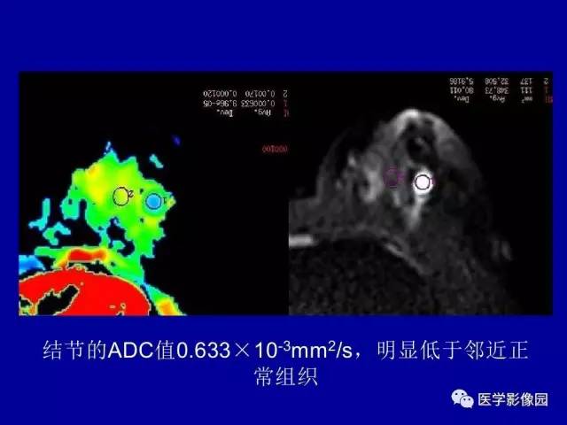 【PPT】乳腺肿瘤影像检查方法与诊断思路
