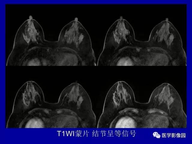 【PPT】乳腺肿瘤影像检查方法与诊断思路