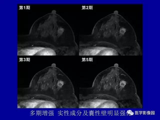 【PPT】乳腺肿瘤影像检查方法与诊断思路