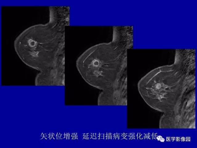 【PPT】乳腺肿瘤影像检查方法与诊断思路