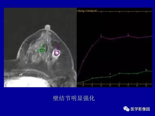 【PPT】乳腺肿瘤影像检查方法与诊断思路