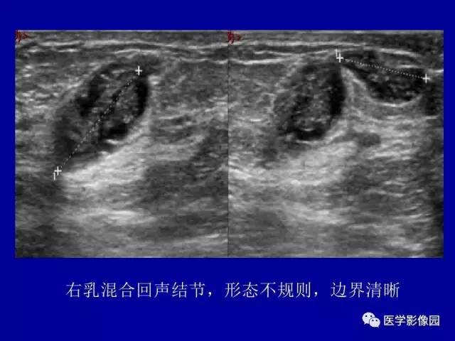 【PPT】乳腺肿瘤影像检查方法与诊断思路
