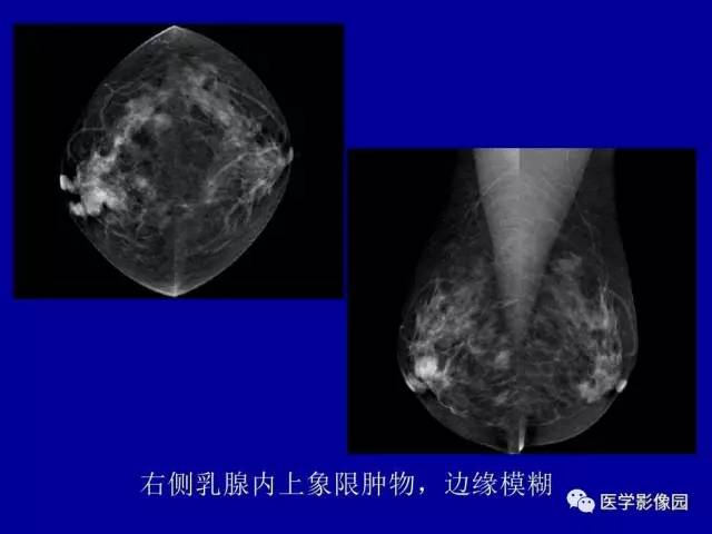 【PPT】乳腺肿瘤影像检查方法与诊断思路