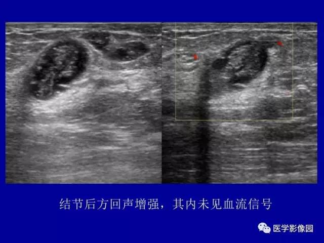 【PPT】乳腺肿瘤影像检查方法与诊断思路