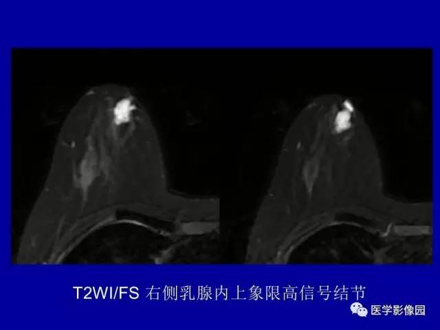 【PPT】乳腺肿瘤影像检查方法与诊断思路