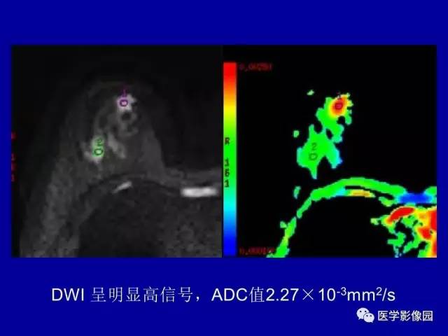 【PPT】乳腺肿瘤影像检查方法与诊断思路