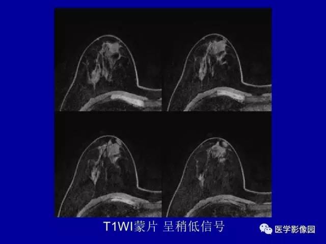 【PPT】乳腺肿瘤影像检查方法与诊断思路