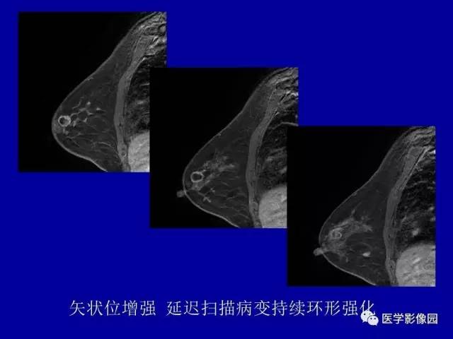 【PPT】乳腺肿瘤影像检查方法与诊断思路