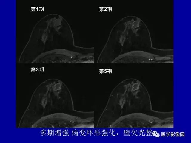 【PPT】乳腺肿瘤影像检查方法与诊断思路
