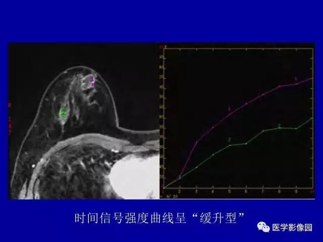 【PPT】乳腺肿瘤影像检查方法与诊断思路