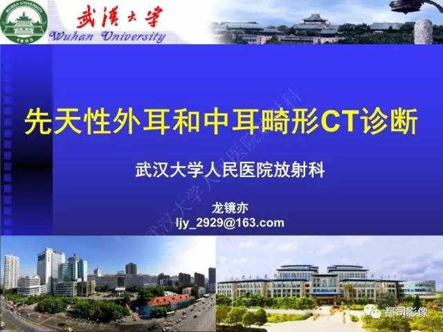 【PPT】先天性外耳和中耳畸形CT诊断