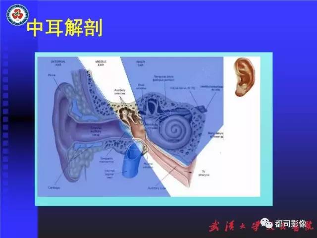 【PPT】先天性外耳和中耳畸形CT诊断