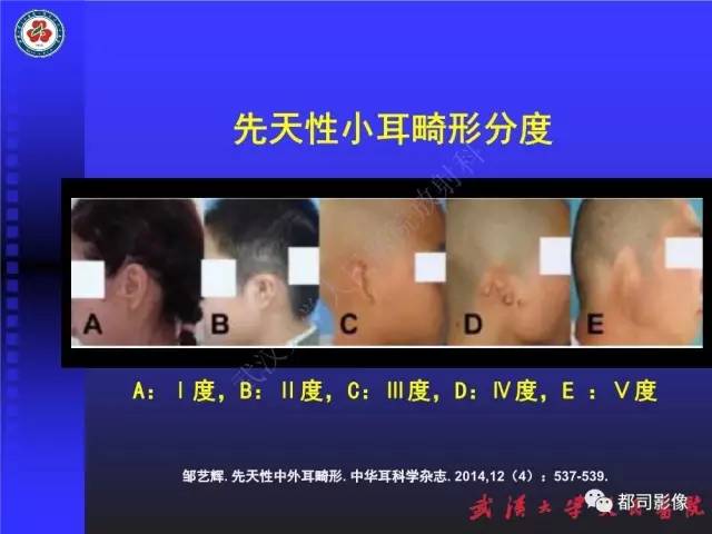 【PPT】先天性外耳和中耳畸形CT诊断