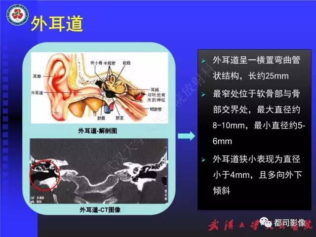 【PPT】先天性外耳和中耳畸形CT诊断