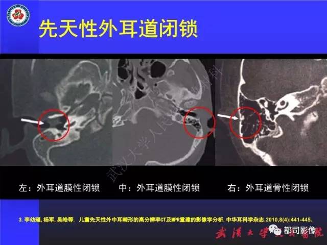 【PPT】先天性外耳和中耳畸形CT诊断