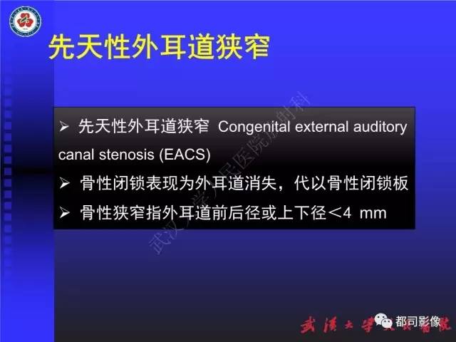 【PPT】先天性外耳和中耳畸形CT诊断