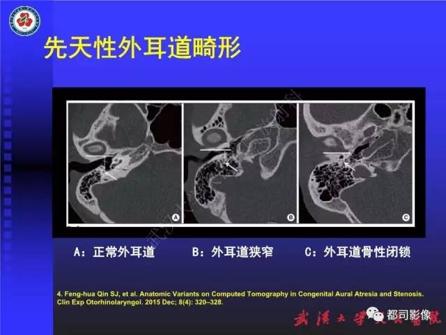 【PPT】先天性外耳和中耳畸形CT诊断
