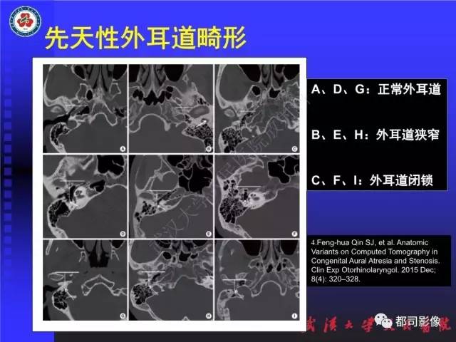 【PPT】先天性外耳和中耳畸形CT诊断