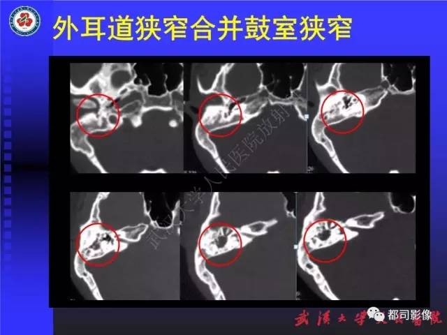 【PPT】先天性外耳和中耳畸形CT诊断
