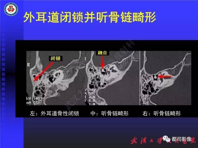 【PPT】先天性外耳和中耳畸形CT诊断