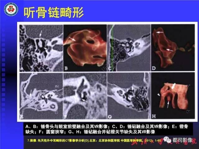 【PPT】先天性外耳和中耳畸形CT诊断