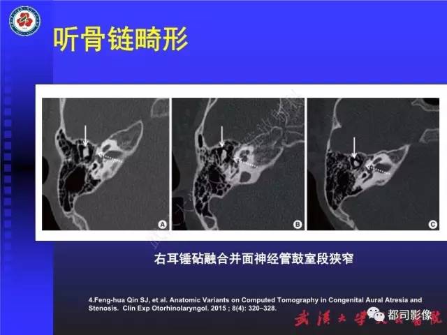 【PPT】先天性外耳和中耳畸形CT诊断