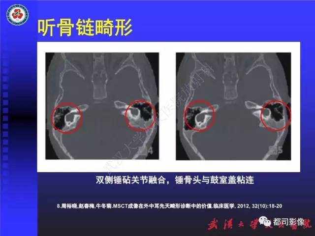 【PPT】先天性外耳和中耳畸形CT诊断