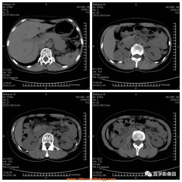 【病例】全身多部位淋巴管瘤1例CT影像表现 【病例】全身多部位淋巴管瘤1例CT影像表现