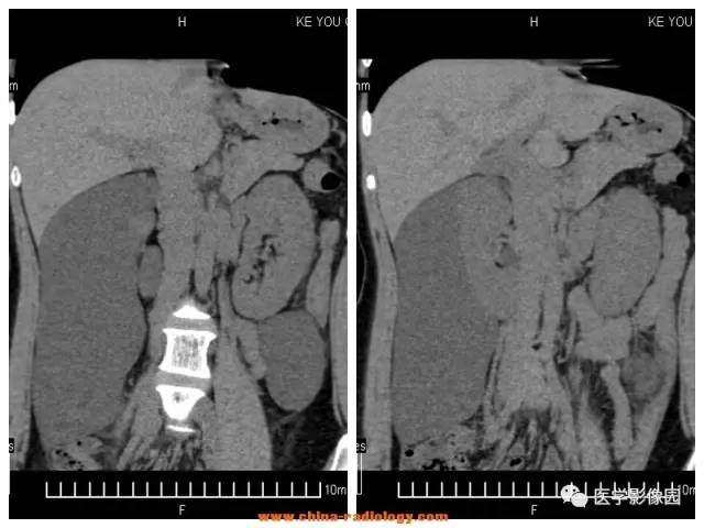 【病例】全身多部位淋巴管瘤1例CT影像表现 【病例】全身多部位淋巴管瘤1例CT影像表现