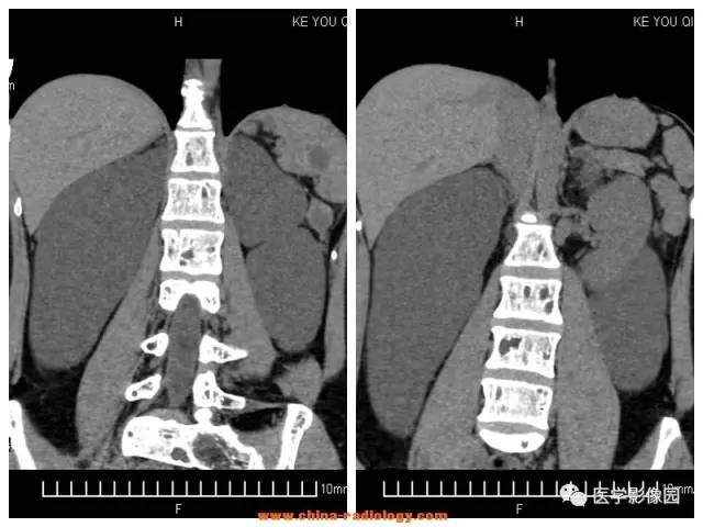 【病例】全身多部位淋巴管瘤1例CT影像表现 【病例】全身多部位淋巴管瘤1例CT影像表现