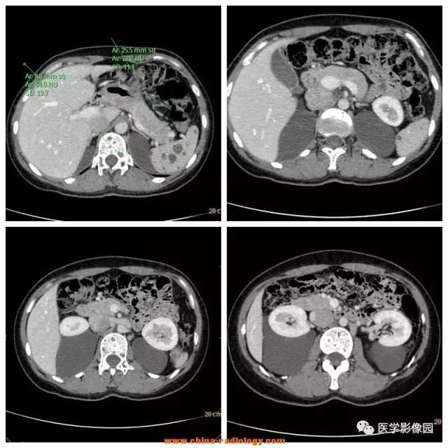 【病例】全身多部位淋巴管瘤1例CT影像表现 【病例】全身多部位淋巴管瘤1例CT影像表现