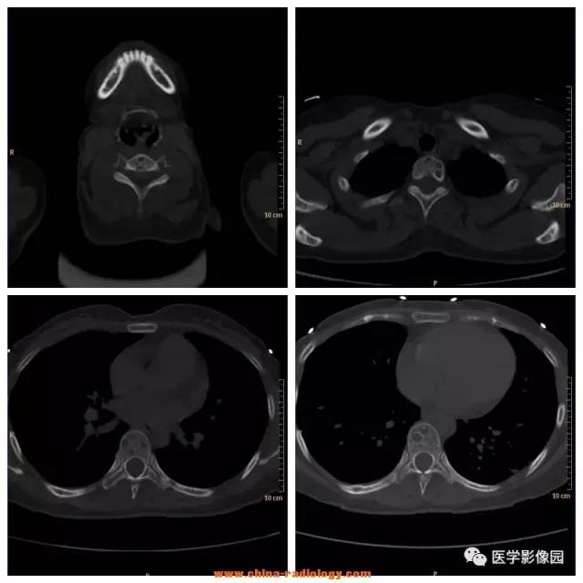 【病例】全身多部位淋巴管瘤1例CT影像表现 【病例】全身多部位淋巴管瘤1例CT影像表现