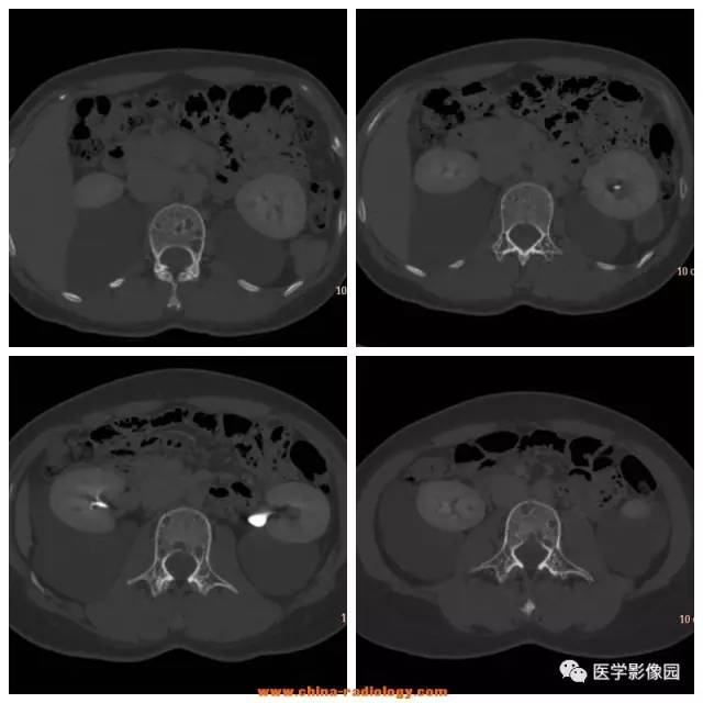 【病例】全身多部位淋巴管瘤1例CT影像表现 【病例】全身多部位淋巴管瘤1例CT影像表现